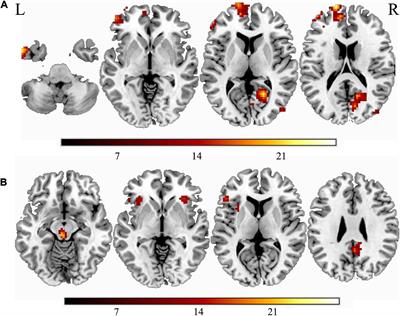 Explore the effects of overweight and smoking on spontaneous brain activity: Independent and reverse